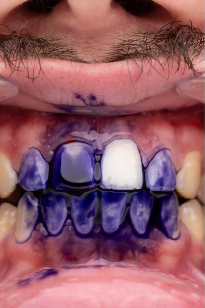 PURPLE V34 - Blanqueador Dental