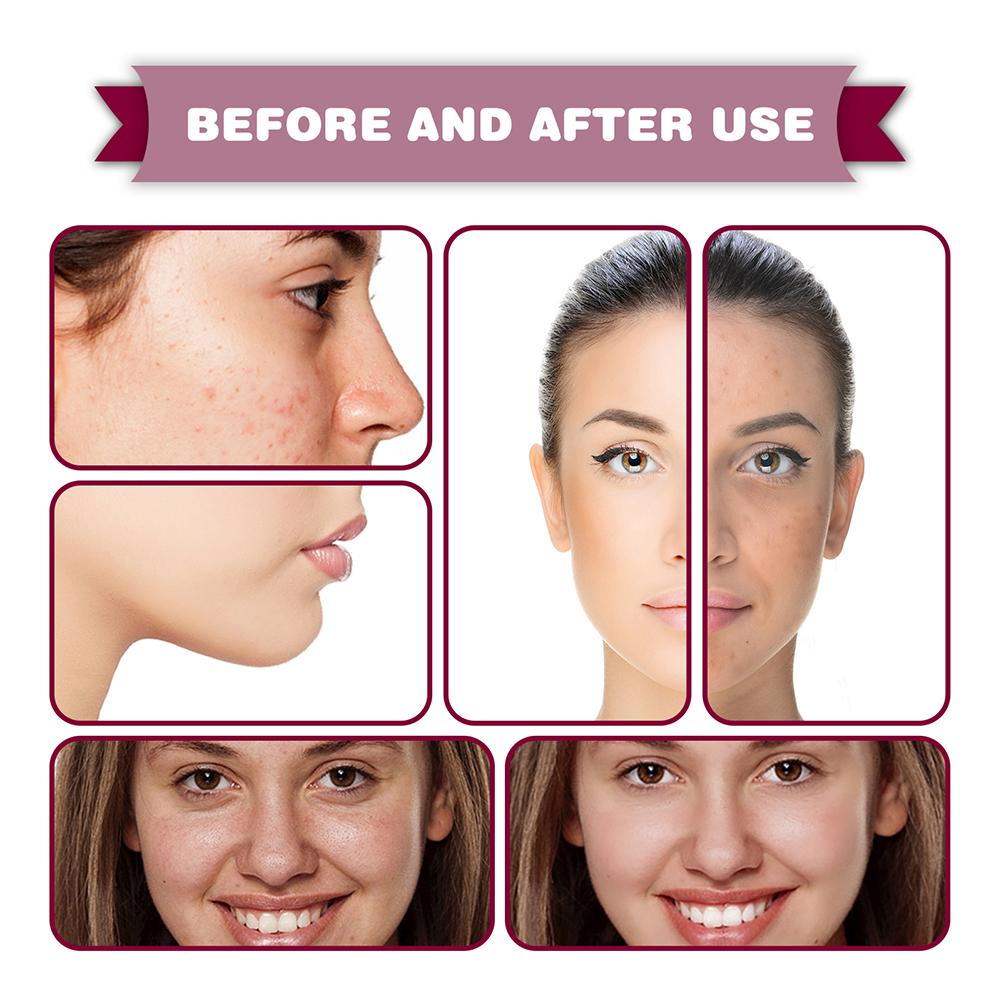 Serum anti-acné / anti-manchas JAYSUING